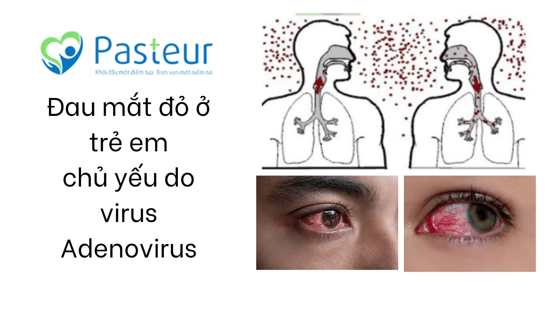 nguyên nhân gây đa mắt đỏ