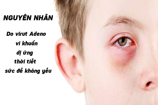 Bệnh đau mắt đỏ ở trẻ em cha mẹ cần lưu ý