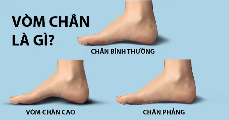 HỘI CHỨNG BÀN CHÂN PHẲNG CÓ CẦN ĐIỀU TRỊ KHÔNG