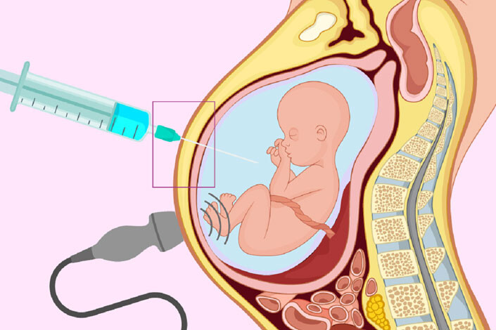 Phôi khảm – Những khuyến cáo mà bạn cần biết Ảnh minh họa