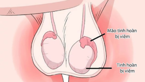 Ở nam giới teo tinh hoàn một bên có bị vô sinh không? Ảnh minh họa