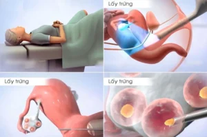 Trữ đông noãn – Phương pháp hiện đại trong điều trị hiếm muộn Ảnh minh họa