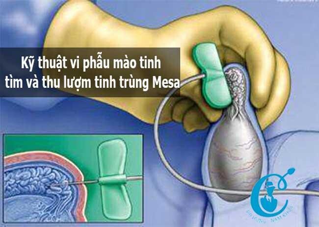 Bị vô sinh nam có phải yếu sinh lý không? - Những điều bạn cần biết Ảnh minh họa