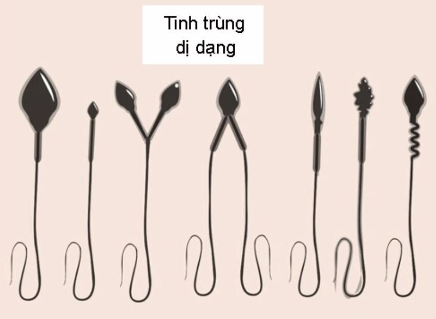 Tổng hợp những điều bạn cần biết về vô sinh ở nam giới Ảnh minh họa