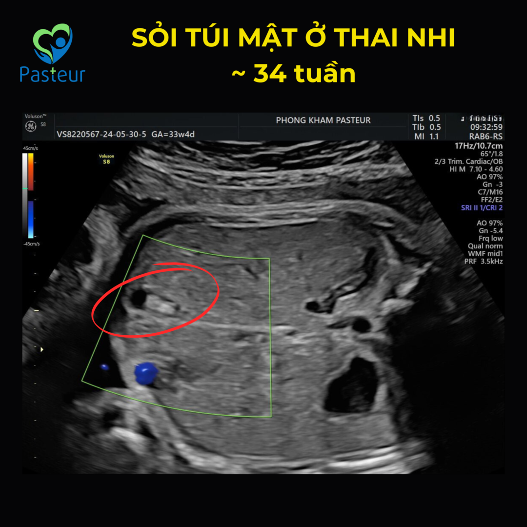 SỎI TÚI MẬT Ở THAI NHI 34 TUẦN Ảnh minh họa