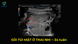 SỎI TÚI MẬT Ở THAI NHI 34 TUẦN Ảnh minh họa