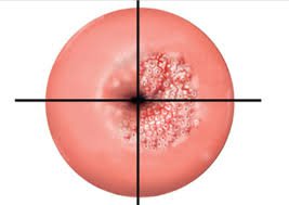 Bệnh ung thư cổ tử cung: Cần biết gì để bảo vệ bản thân?