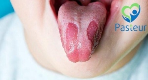 Lưỡi Bản Đồ (Viêm Lưỡi Di Trú Lành Tính): Nguyên Nhân, Triệu Chứng & Cách Điều Trị Ảnh minh họa