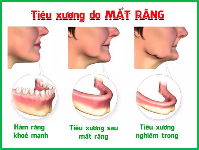 Tác hại của việc mất răng: Nguy cơ sức khỏe và ảnh hưởng đến cuộc sống hàng ngày Tác hại của việc mất răng: Nguy cơ sức khỏe và ảnh hưởng đến cuộc sống hàng ngày
