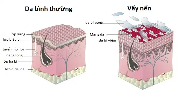 Bệnh vẩy nến căn nguyên và điều trị bệnh Ảnh minh họa