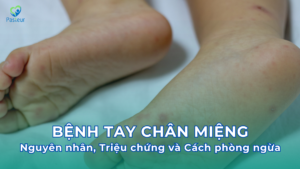 Bệnh tay chân miệng Nguyên nhân triệu chứng và cách phòng ngừa Ảnh minh họa