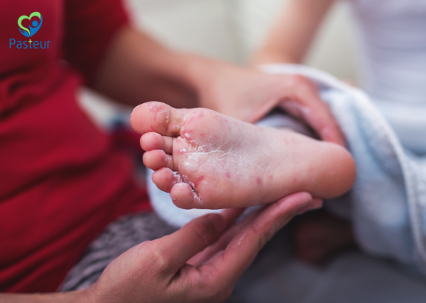Bệnh tay chân miệng Nguyên nhân triệu chứng và cách phòng ngừa Ảnh minh họa