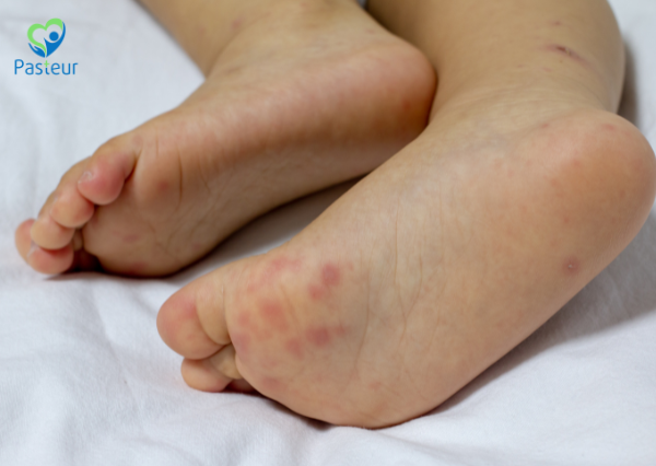 bệnh tay chân miệng