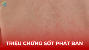 Sốt phát ban 3 triệu chứng điển hình Ảnh minh họa