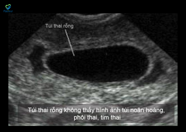 siêu âm có túi thai nhưng chưa thấy phôi thai
