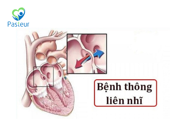 thông liên nhĩ ở trẻ em