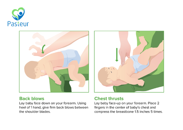 xử trí trẻ bị sặc sữa
