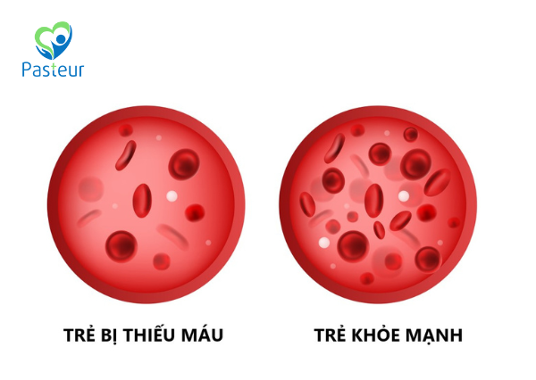 nguyên nhân thiếu máu thiếu sắt ở trẻ em
