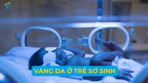 VÀNG DA Ở TRẺ SƠ SINH Ảnh minh họa