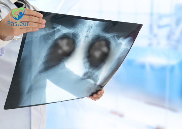 viêm phổi cộng đồng