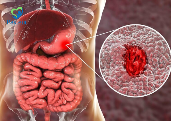 xuất huyết tiêu hóa trên