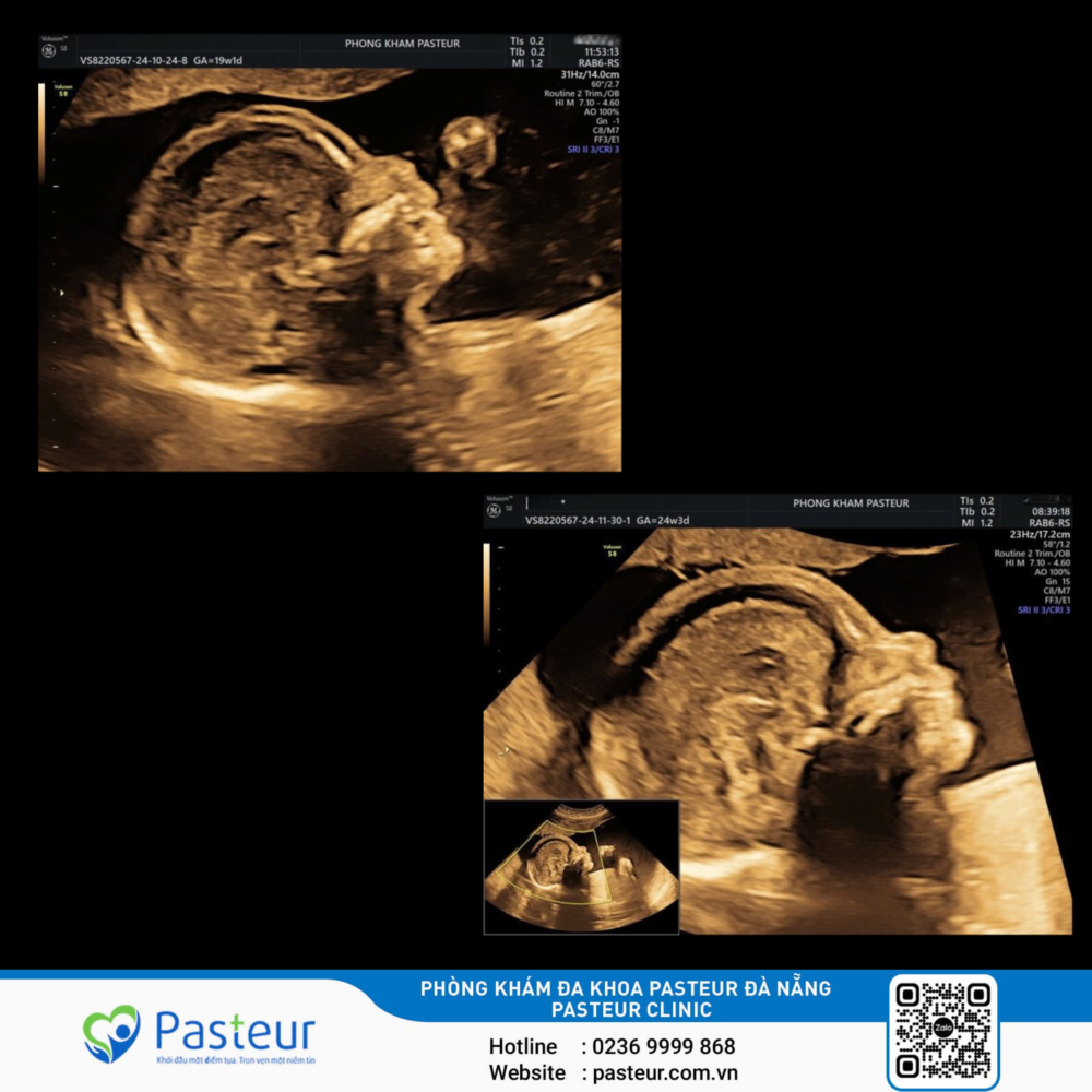 LẶP ĐOẠN NHIỄM SẮC THỂ SỐ 2 Ở THAI NHI: MỘT TRƯỜNG HỢP HIẾM GẶP 1 Hình ảnh siêu âm của thai nhi có bất thường lặp đoạn nhiễm sắc thể số 2