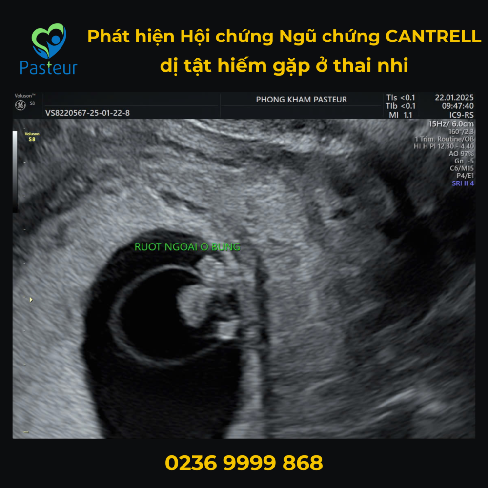 PHÁT HIỆN HỘI CHỨNG CANTRELL – MỘT BẤT THƯỜNG BẨM SINH HIẾM GẶP Ở THAI NHI QUA SIÊU ÂM 3 PHÁT HIỆN HỘI CHỨNG CANTRELL – MỘT BẤT THƯỜNG BẨM SINH HIẾM GẶP Ở THAI NHI QUA SIÊU ÂM Ảnh minh họa