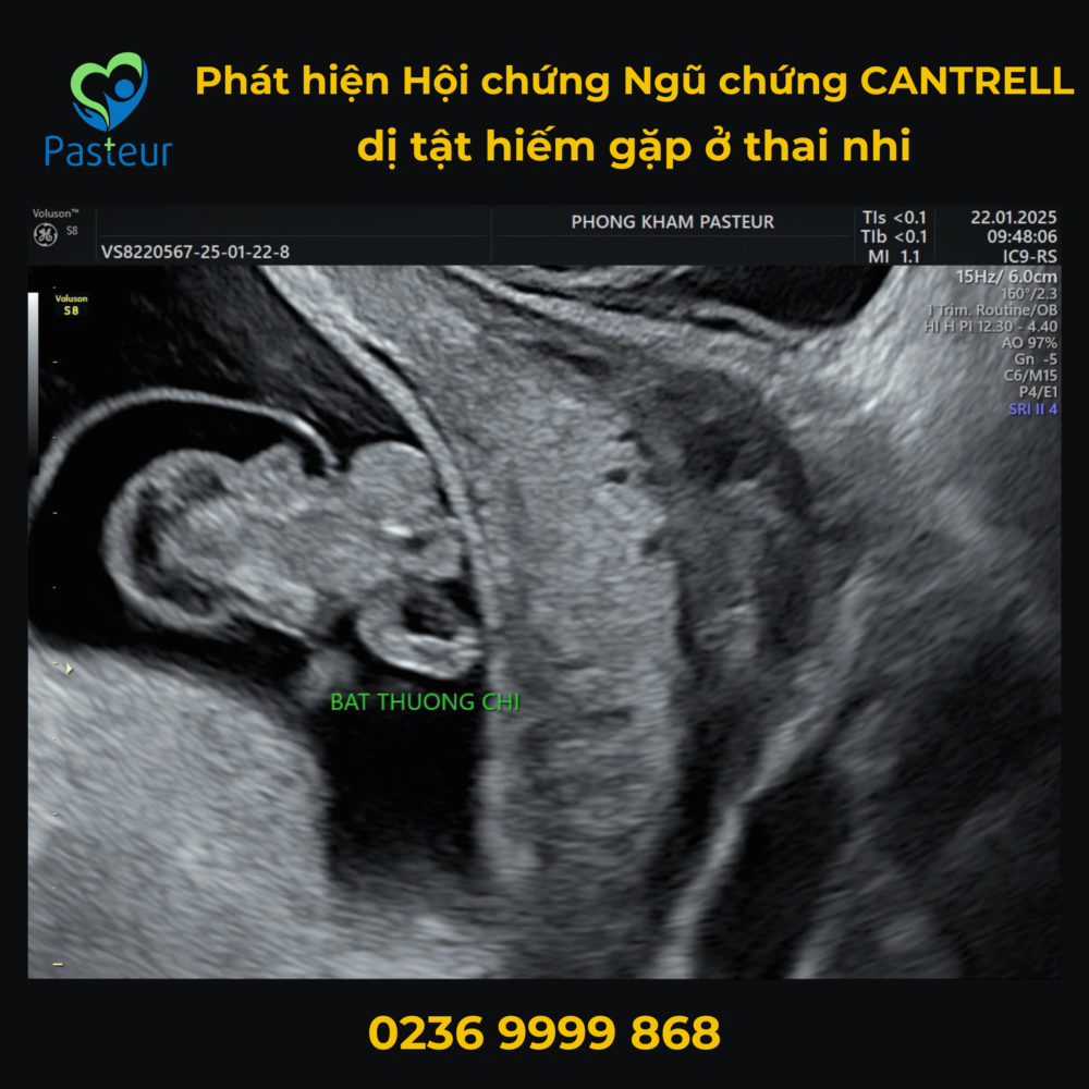 PHÁT HIỆN HỘI CHỨNG CANTRELL – MỘT BẤT THƯỜNG BẨM SINH HIẾM GẶP Ở THAI NHI QUA SIÊU ÂM 1 PHÁT HIỆN HỘI CHỨNG CANTRELL – MỘT BẤT THƯỜNG BẨM SINH HIẾM GẶP Ở THAI NHI QUA SIÊU ÂM Ảnh minh họa