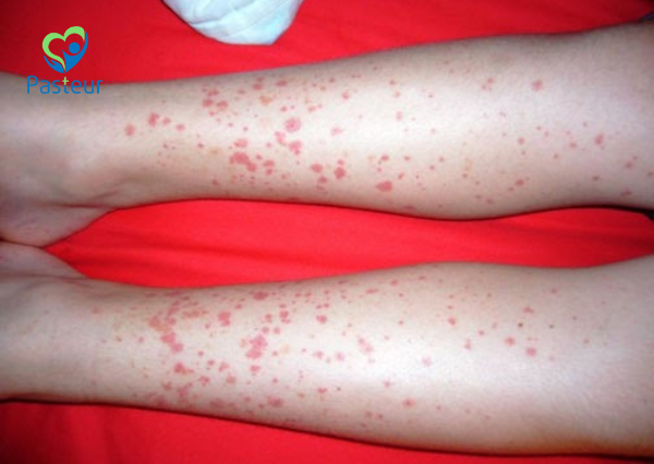 SCHONLEIN HENOCH – VIÊM MẠCH MÁU IgA (IgA VASCULITIS- IgAV) Ảnh minh họa