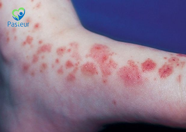 viêm mạch máu IgA