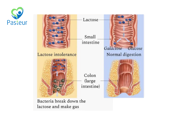 bất dung nạp đường lactose
