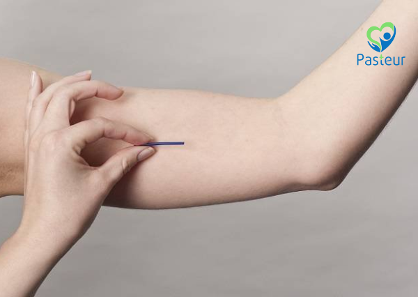 cấy que tránh thai có gây tăng cân