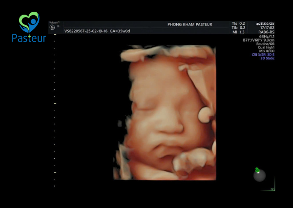 SIÊU ÂM THAI 4D CẦN ĐƯỢC THỰC HIỆN KHI NÀO Ảnh minh họa