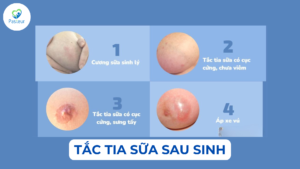 TẮC TIA SỮA NGUYÊN NHÂN DẤU HIỆU VÀ CÁCH PHÒNG NGỪA Ảnh minh họa