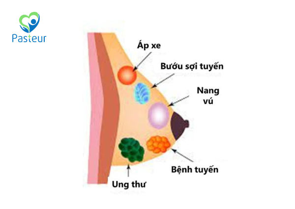 Bệnh vú lành tính