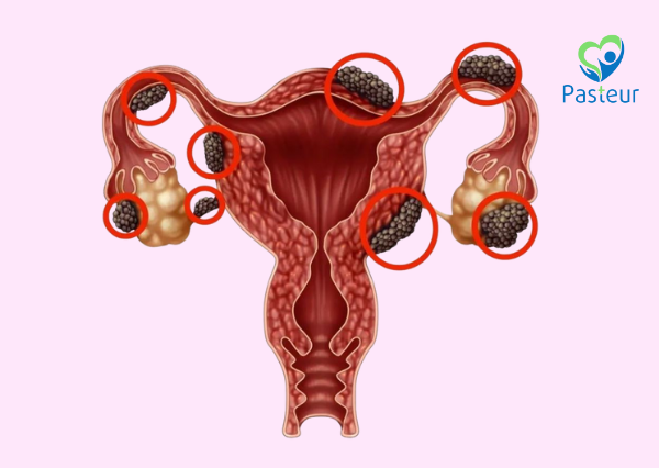điều trị cơn đau do lạc nội mạc tử cung