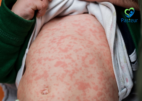 sởi và tác động nguy hiểm đến hệ miễn dịch