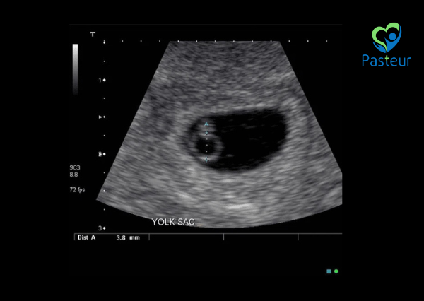 Siêu âm thai có yolksac là gì? Dấu hiệu cho thấy thai đã vào tử cung! 1 siêu âm thai có yolksac là gì