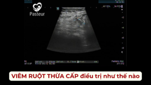 VIÊM RUỘT THỪA CẤP ĐIỀU TRỊ NHƯ THẾ NÀO Ảnh minh họa