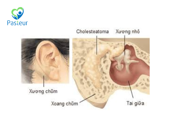 VIÊM TAI XƯƠNG CHŨM NẾU VIÊM TAI GIỮA Ứ MỦ TÁI PHÁT NHIỀU LẦN Ảnh minh họa