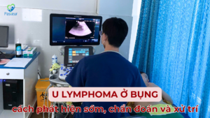 U Lymphoma Ở Bụng và 4 hướng xử trí 13 U Lymphoma Ở Bụng và 4 hướng xử trí Ảnh minh họa