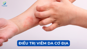 ĐIỀU TRỊ VIÊM DA CƠ ĐỊA (ATOPIC DERMATITIS) Ảnh minh họa