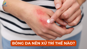 BỎNG DA NÊN XỬ TRÍ NHƯ THẾ NÀO? Ảnh minh họa