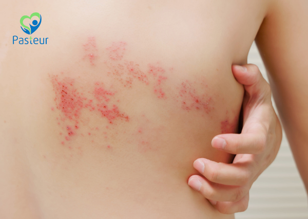 ZONA (SHINGLES) CÓ NGUY HIỂM HAY KHÔNG? 1 zona có nguy hiểm hay không