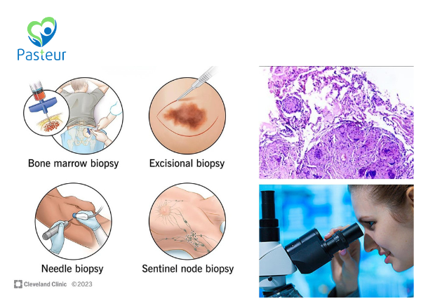 KHI SINH THIẾT KẾT QUẢ LÀ UNG THƯ: CÓ CẦN SINH THIẾT LẠI? 1 KHI SINH THIẾT KẾT QUẢ LÀ UNG THƯ: CÓ CẦN SINH THIẾT LẠI? Ảnh minh họa