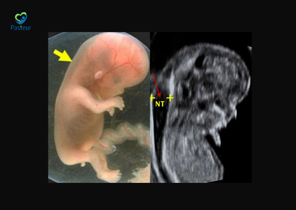 Độ mờ da gáy tăng có nguy hiểm không? Chỉ số bình thường theo tuần thai Ảnh minh họa