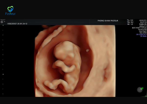 siêu âm 12 tuần