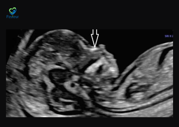 XƯƠNG MŨI THAI NHI NHỮNG ĐIỀU MẸ BẦU CẦN BIẾT Ảnh minh họa