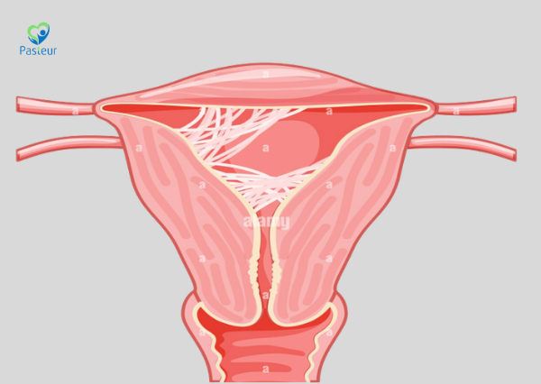 DÍNH BUỒNG TỬ CUNG CÓ ẢNH HƯỞNG ĐẾN KHẢ NĂNG SINH SẢN KHÔNG Ảnh minh họa