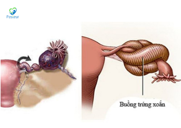 Xoắn buồng trứng cần xử trí ra sao Ảnh minh họa